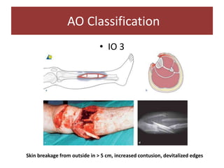• IO 3
AO Classification
Skin breakage from outside in > 5 cm, increased contusion, devitalized edges
 