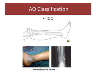 • IC 1
AO Classification
No evident skin lesion
 