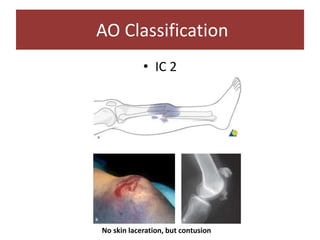 • IC 2
AO Classification
No skin laceration, but contusion
 