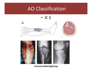 • IC 3
AO Classification
Circumscribed degloving
 