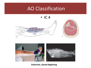 • IC 4
AO Classification
Extensive, closed degloving
 