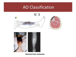 IC 5
AO Classification
Necrosis from contusion
 