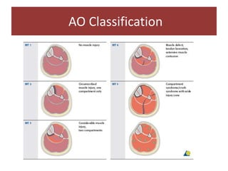 AO Classification
 