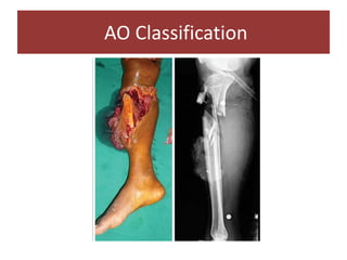 AO Classification
 