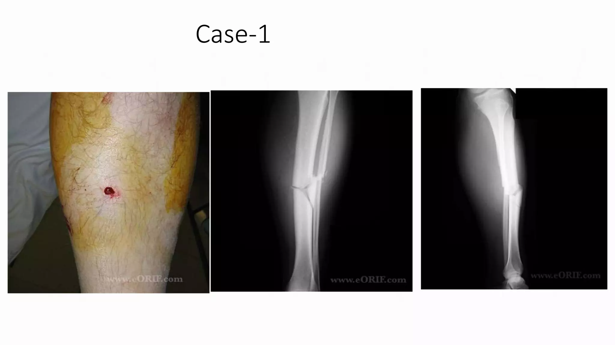 Open fractures ppt | PPT
