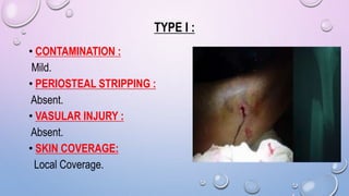 TYPE I :
• CONTAMINATION :
Mild.
• PERIOSTEAL STRIPPING :
Absent.
• VASULAR INJURY :
Absent.
• SKIN COVERAGE:
Local Coverage.
 