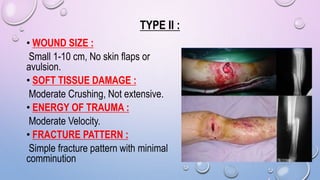 TYPE II :
• WOUND SIZE :
Small 1-10 cm, No skin flaps or
avulsion.
• SOFT TISSUE DAMAGE :
Moderate Crushing, Not extensive.
• ENERGY OF TRAUMA :
Moderate Velocity.
• FRACTURE PATTERN :
Simple fracture pattern with minimal
comminution
 