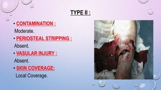 TYPE II :
• CONTAMINATION :
Moderate.
• PERIOSTEAL STRIPPING :
Absent.
• VASULAR INJURY :
Absent.
• SKIN COVERAGE:
Local Coverage.
 