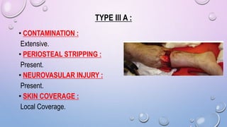 TYPE III A :
• CONTAMINATION :
Extensive.
• PERIOSTEAL STRIPPING :
Present.
• NEUROVASULAR INJURY :
Present.
• SKIN COVERAGE :
Local Coverage.
 