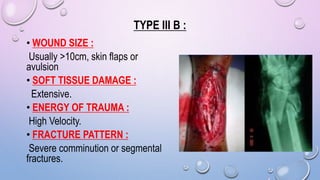TYPE III B :
• WOUND SIZE :
Usually >10cm, skin flaps or
avulsion
• SOFT TISSUE DAMAGE :
Extensive.
• ENERGY OF TRAUMA :
High Velocity.
• FRACTURE PATTERN :
Severe comminution or segmental
fractures.
 