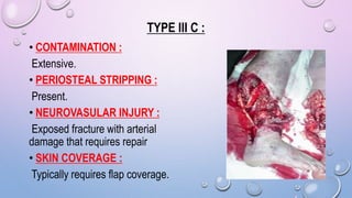 TYPE III C :
• CONTAMINATION :
Extensive.
• PERIOSTEAL STRIPPING :
Present.
• NEUROVASULAR INJURY :
Exposed fracture with arterial
damage that requires repair
• SKIN COVERAGE :
Typically requires flap coverage.
 