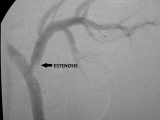 ESTENOSIS 