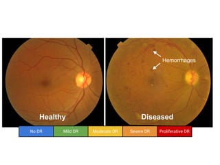 Healthy Diseased
Hemorrhages
No DR Mild DR Moderate DR Severe DR Proliferative DR
1 2 3 4 5
 