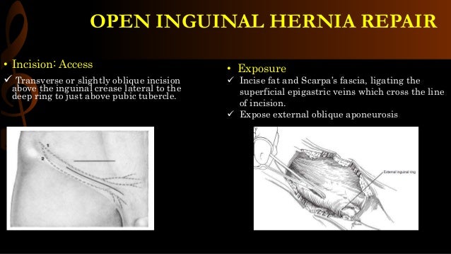 Open Inguinal Hernia Repair Operative Surgery Open Inguinal Hernia Repair Operative Surgery