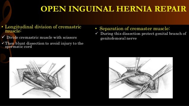 Open inguinal hernia repair / operative surgery