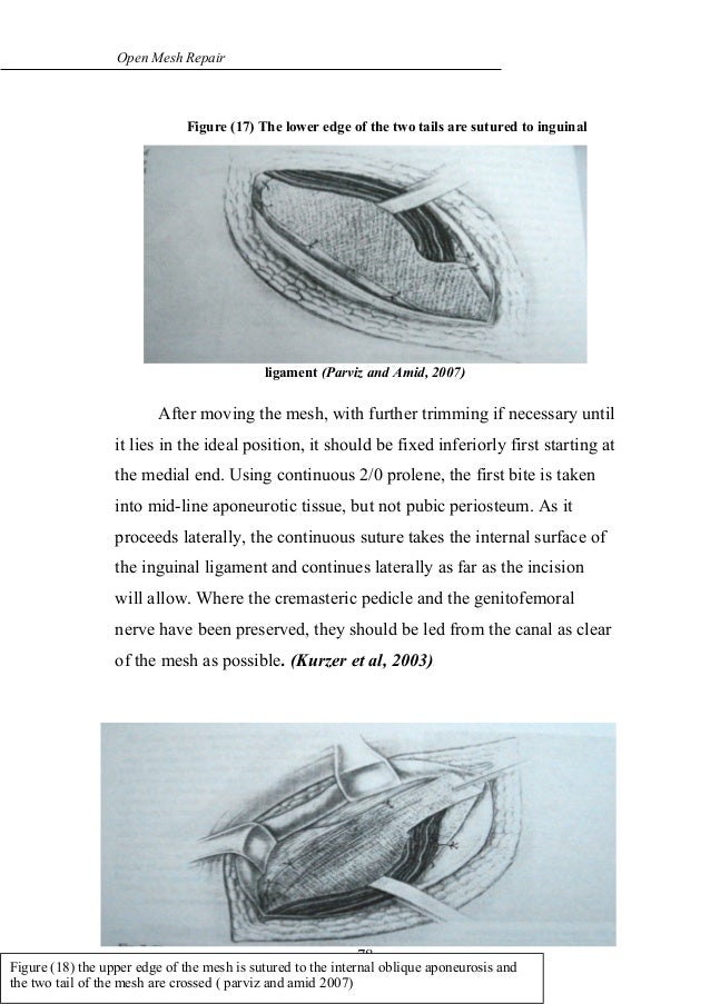 Open mesh repair of inguinal hernias