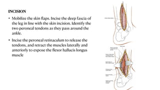 Foot Incision Approaches to foot and ankle Presentation.pdf