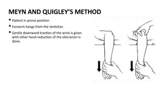 MEYN AND QUIGLEY’S METHOD
• Pa)ent in prone posi)on.
• Forearm hangs from the stretcher.
• Gentle downward trac)on of the wrist is given
with other hand reduc)on of the olecranon is
done.
 