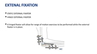 EXTENAL FIXATION
• STATIC EXTERNAL FIXATOR
• HINGE EXTERNAL FIXATOR
• A hinged ﬁxator will allow for range of mo)on exercises to be performed while the external
ﬁxator is in place.
 