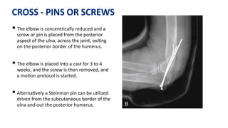 CROSS - PINS OR SCREWS
• The elbow is concentrically reduced and a
screw or pin is placed from the posterior
aspect of the ulna, across the joint, exi)ng
on the posterior border of the humerus.
• The elbow is placed into a cast for 3 to 4
weeks, and the screw is then removed, and
a mo)on protocol is started.
• Alterna)vely a Steinman pin can be u)lized
driven from the subcutaneous border of the
ulna and out the posterior humerus.
 