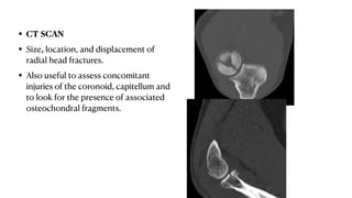 • CT SCAN
• Size, location, and displacement of
radial head fractures.
• Also useful to assess concomitant
injuries of the coronoid, capitellum and
to look for the presence of associated
osteochondral fragments.
 