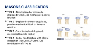 MASONS CLASSIFICATION
• TYPE 1 - Nondisplaced or minimally
displaced (<2mm), no mechanical block to
rota)on
• TYPE 2 - Displaced >2mm or angulated,
possible mechanical block to forearm
rota)on
• TYPE 3 -Comminuted and displaced,
mechanical block to mo)on
• TYPE 4 - Radial head fracture with elbow
disloca)on (HOTCHKISS/JOHNSTON
modiﬁca)on of TYPE 3)
 