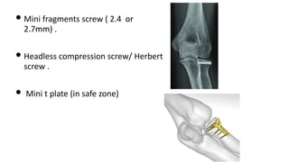• Mini fragments screw ( 2.4 or
2.7mm) .
• Headless compression screw/ Herbert
screw .
• Mini t plate (in safe zone)
 