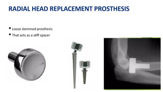 RADIAL HEAD REPLACEMENT PROSTHESIS
• Loose stemmed prosthesis
• That acts as a s)ﬀ spacer
 