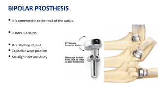 BIPOLAR PROSTHESIS
• It is cemented in to the neck of the radius.
• COMPLICATIONS
• Overstuﬃng of joint
• Capitellar wear problem
• Malalignment instability
 