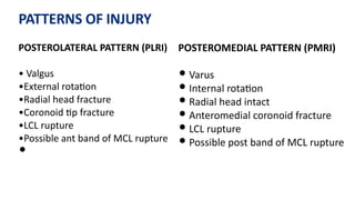 PATTERNS OF INJURY
POSTEROLATERAL PATTERN (PLRI)
• Valgus
•External rota)on
•Radial head fracture
•Coronoid )p fracture
•LCL rupture
•Possible ant band of MCL rupture
•
POSTEROMEDIAL PATTERN (PMRI)
• Varus
• Internal rota)on
• Radial head intact
• Anteromedial coronoid fracture
• LCL rupture
• Possible post band of MCL rupture
 