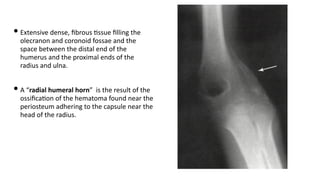 • Extensive dense, ﬁbrous )ssue ﬁlling the
olecranon and coronoid fossae and the
space between the distal end of the
humerus and the proximal ends of the
radius and ulna.
• A “radial humeral horn” is the result of the
ossiﬁca)on of the hematoma found near the
periosteum adhering to the capsule near the
head of the radius.
 