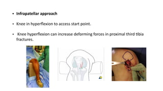 Tibia shaft fracture and fibula shaft fracture | PDF