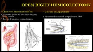 • Closure of mesenteric defect
 Close the defect without including the
blood vessels
 Keep a drain close to anastomosis
• Closure of Laparotomy
 By mass closure with 1-0 prolene or PDS
OPEN RIGHT HEMICOLECTOMY
 