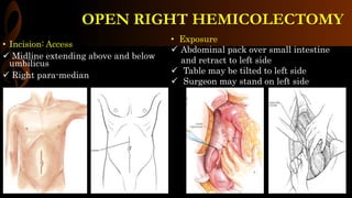 • Incision: Access
 Midline extending above and below
umbilicus
 Right para-median
• Exposure
 Abdominal pack over small intestine
and retract to left side
 Table may be tilted to left side
 Surgeon may stand on left side
OPEN RIGHT HEMICOLECTOMY
 
