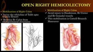 • Mobilisation of Right Colon
 Incise the whiteline of Toldt upto
hepatic flexure
 Mobilise Rt Colon from
retroperitoneal structures
• Mobilisation of Right Colon
 Avoid injury to Duodenum, Rt Ureter
and Rt Gonadal vessels
 This mobilisation is Cattell-Braasch
Maneuver
OPEN RIGHT HEMICOLECTOMY
 