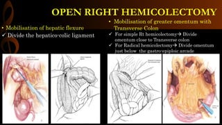 • Mobilisation of hepatic flexure
 Divide the hepatico-colic ligament
• Mobilisation of greater omentum with
Transverse Colon
 For simple Rt hemicolectomy Divide
omentum close to Transverse colon
 For Radical hemicolectomy Divide omentum
just below the gastro-epiploic arcade
OPEN RIGHT HEMICOLECTOMY
 