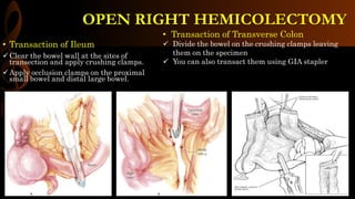 • Transaction of Ileum
Clear the bowel wall at the sites of
transection and apply crushing clamps.
Apply occlusion clamps on the proximal
small bowel and distal large bowel.
• Transaction of Transverse Colon
 Divide the bowel on the crushing clamps leaving
them on the specimen
 You can also transact them using GIA stapler
OPEN RIGHT HEMICOLECTOMY
 
