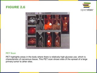 FIGURE 2.6
PET Scan
PET highlights areas in the body where there is relatively high glucose use, which is
characteristic of cancerous tissue. This PET scan shows sites of the spread of a large
primary tumor to other sites.
 