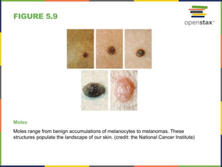 FIGURE 5.9
Moles
Moles range from benign accumulations of melanocytes to melanomas. These
structures populate the landscape of our skin. (credit: the National Cancer Institute)
 