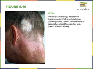 FIGURE 5.10
Vitiligo
Individuals with vitiligo experience
depigmentation that results in lighter
colored patches of skin. The condition is
especially noticeable on darker skin.
(credit: Klaus D. Peter)
 
