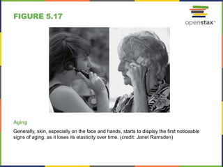 FIGURE 5.17
Aging
Generally, skin, especially on the face and hands, starts to display the first noticeable
signs of aging, as it loses its elasticity over time. (credit: Janet Ramsden)
 