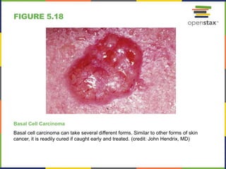 FIGURE 5.18
Basal Cell Carcinoma
Basal cell carcinoma can take several different forms. Similar to other forms of skin
cancer, it is readily cured if caught early and treated. (credit: John Hendrix, MD)
 