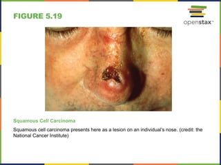 FIGURE 5.19
Squamous Cell Carcinoma
Squamous cell carcinoma presents here as a lesion on an individual’s nose. (credit: the
National Cancer Institute)
 