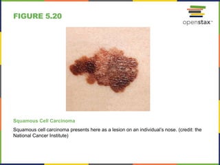 FIGURE 5.20
Squamous Cell Carcinoma
Squamous cell carcinoma presents here as a lesion on an individual’s nose. (credit: the
National Cancer Institute)
 
