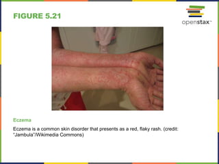 FIGURE 5.21
Eczema
Eczema is a common skin disorder that presents as a red, flaky rash. (credit:
“Jambula”/Wikimedia Commons)
 