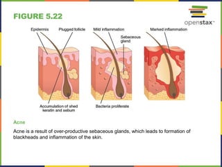 FIGURE 5.22
Acne
Acne is a result of over-productive sebaceous glands, which leads to formation of
blackheads and inflammation of the skin.
 