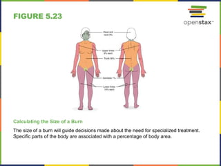 FIGURE 5.23
Calculating the Size of a Burn
The size of a burn will guide decisions made about the need for specialized treatment.
Specific parts of the body are associated with a percentage of body area.
 