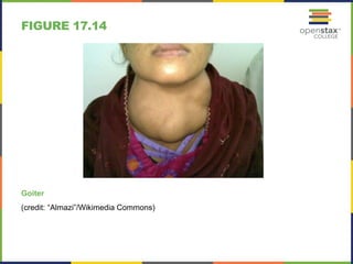 FIGURE 17.14 
Goiter 
(credit: “Almazi”/Wikimedia Commons) 
 