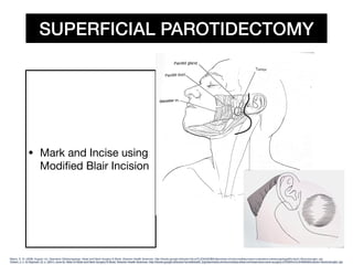 Parotidectomy Superficial Orlhns Technique PDF parotidectomy-superficial-orlhns-technique-pdf
