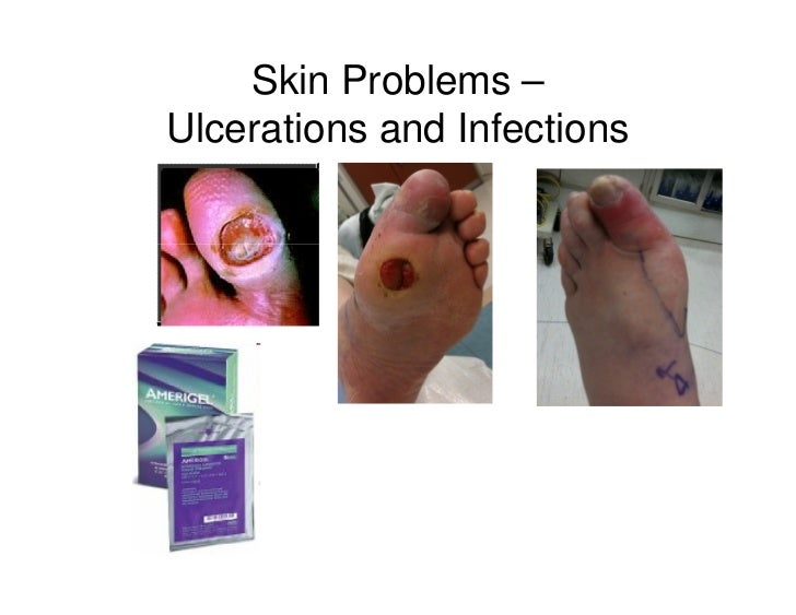 Comprehensive Diabetic Foot Examination